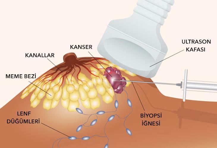 Biyopsi